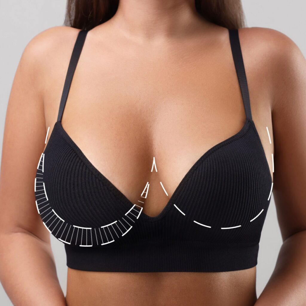 Breast Uplift with Dr. Sof at one of his clinics