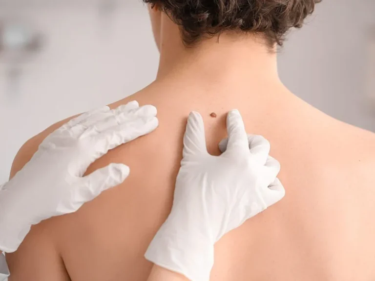 Mole Removal Manchester with Dr. Sof