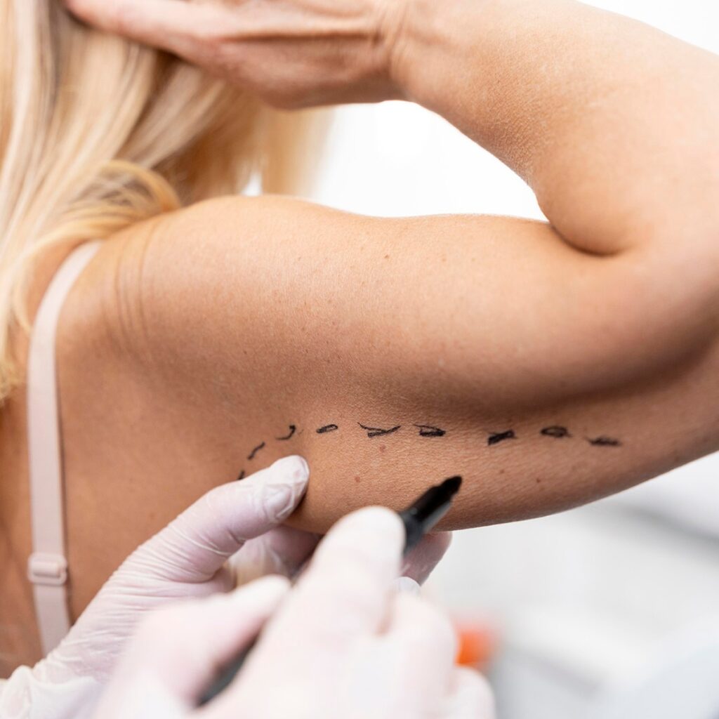 Arm Lift Surgery with Dr. Sof Cheshire