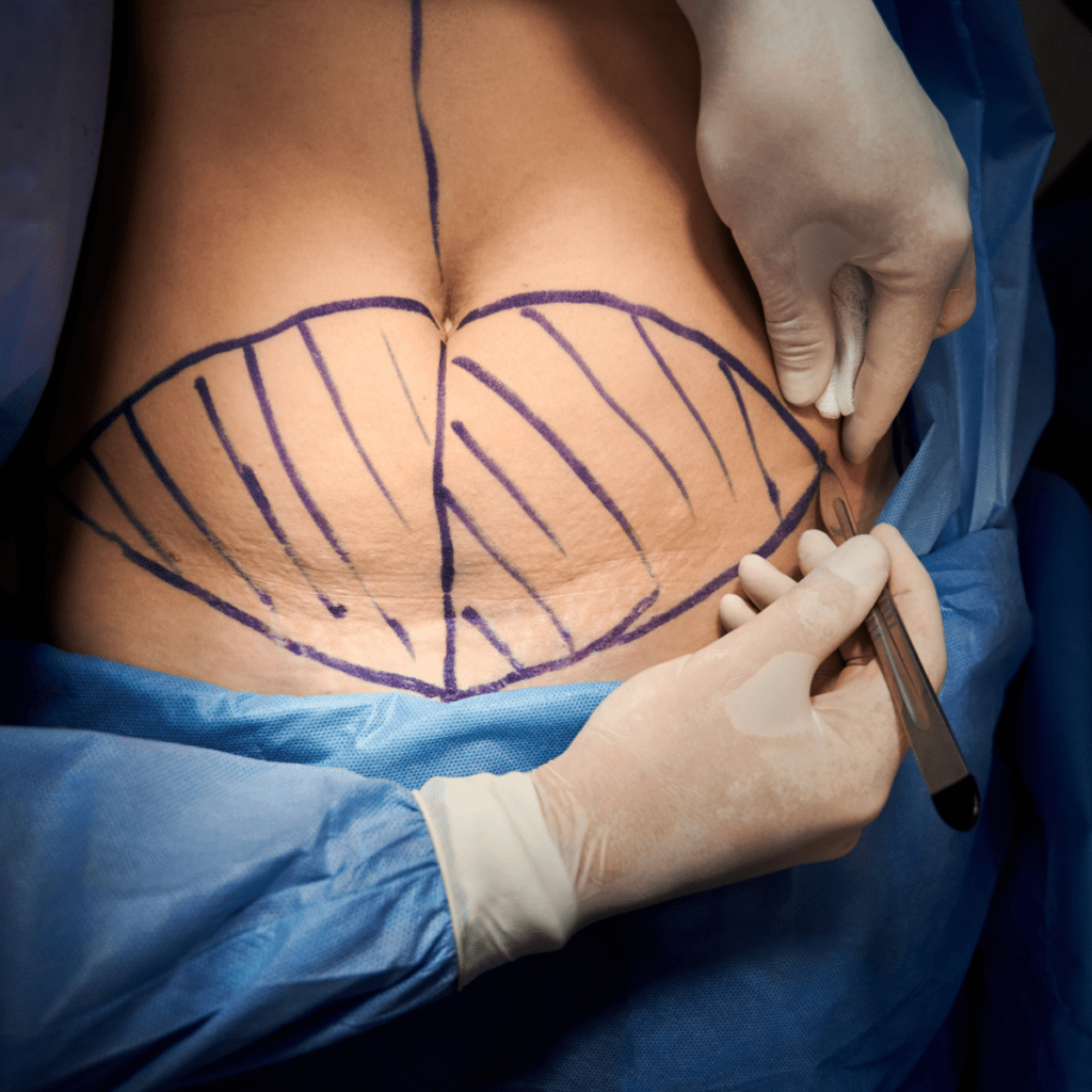 Mini Abdominoplasty Dr. Sof in Cheshire