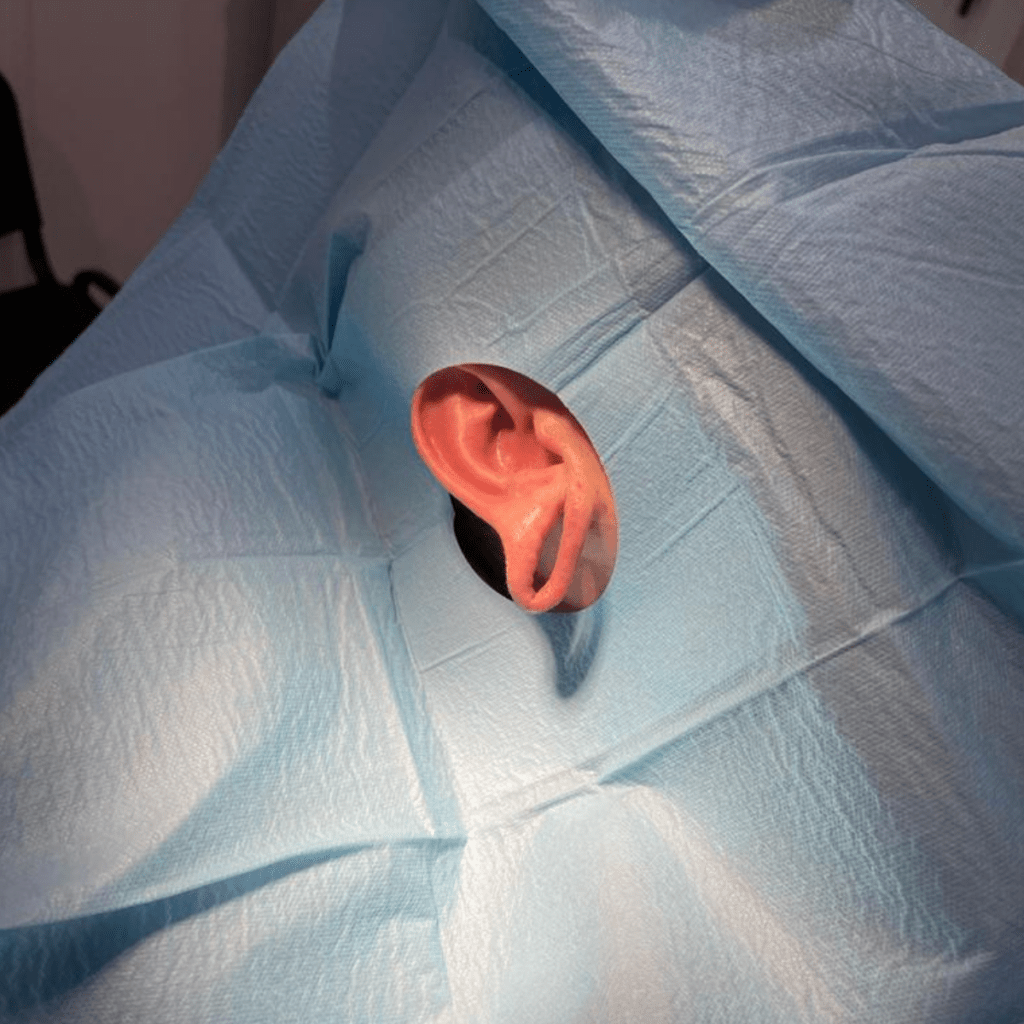 Split Earlobe Correction with Dr. Sof