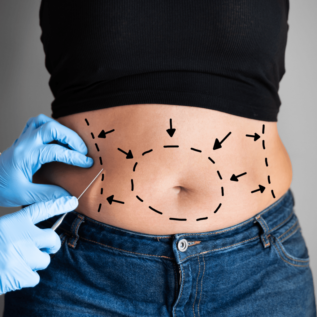 Why choose a Mini Abdominoplasty with Dr. Sof in Cheshire