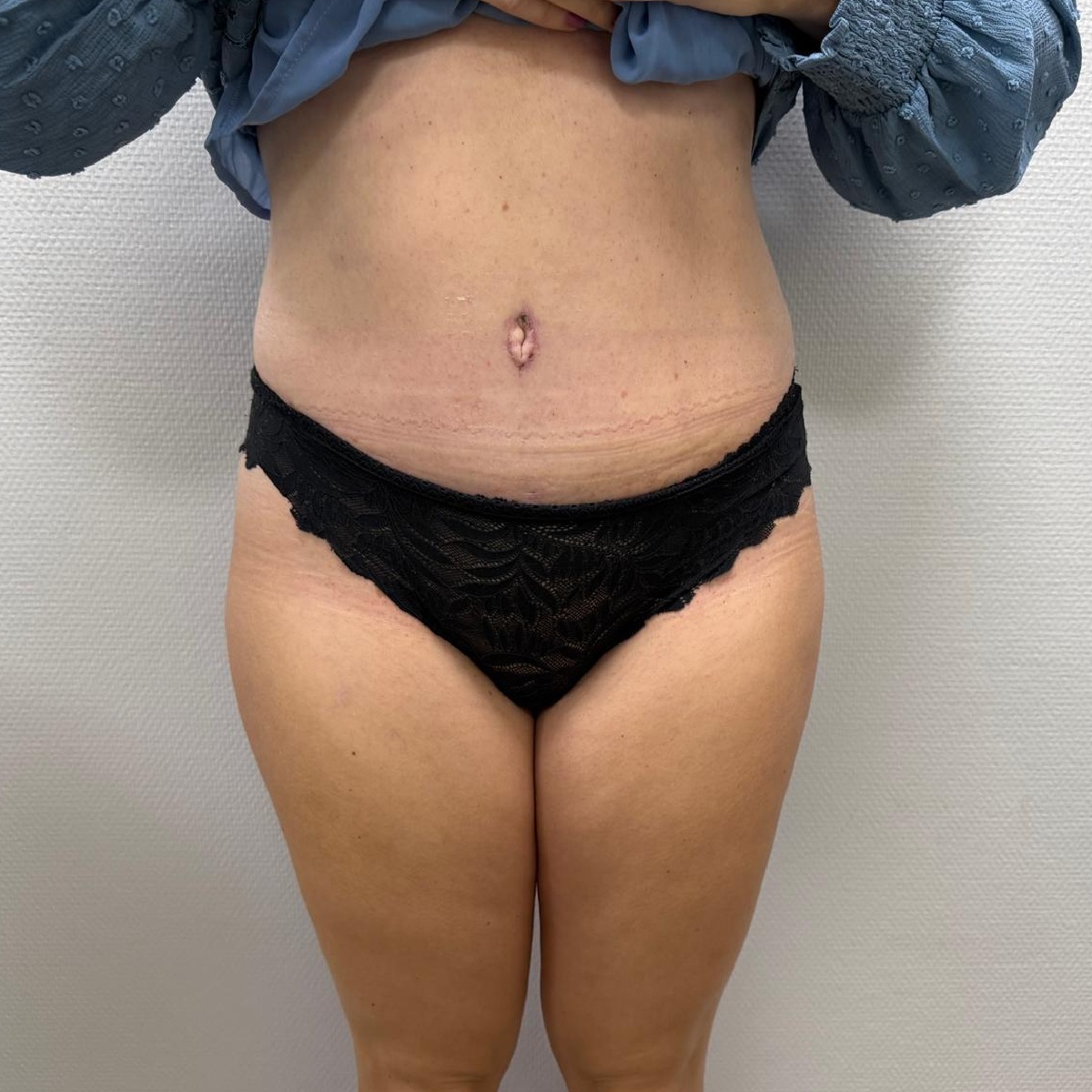 Abdominoplasty After Front Angle with Dr. Sof