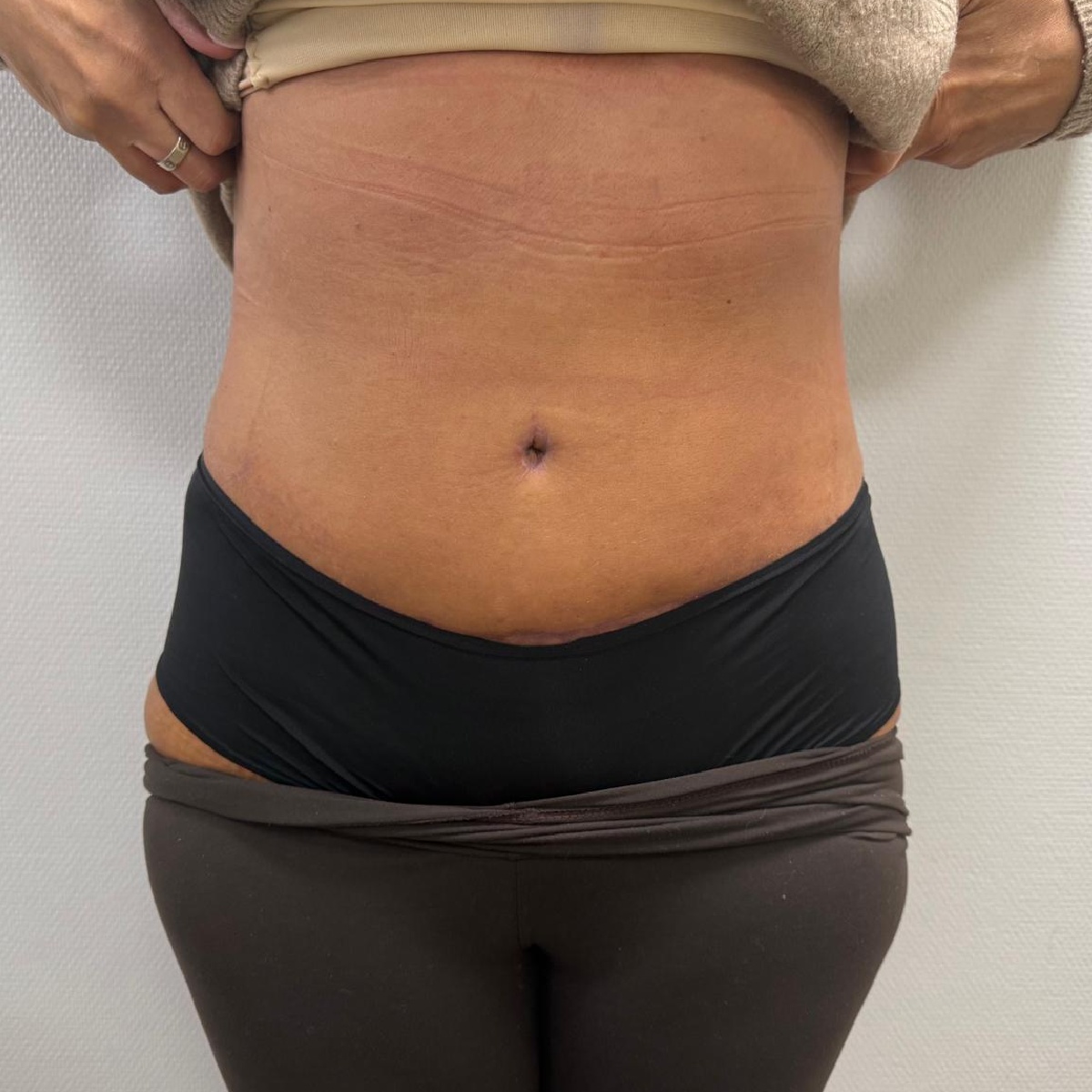 Abdominoplasty After Results with Renovatio Clinic