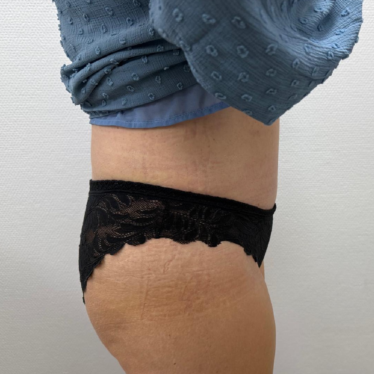 Abdominoplasty After Side Angle 2 with Dr. Sof