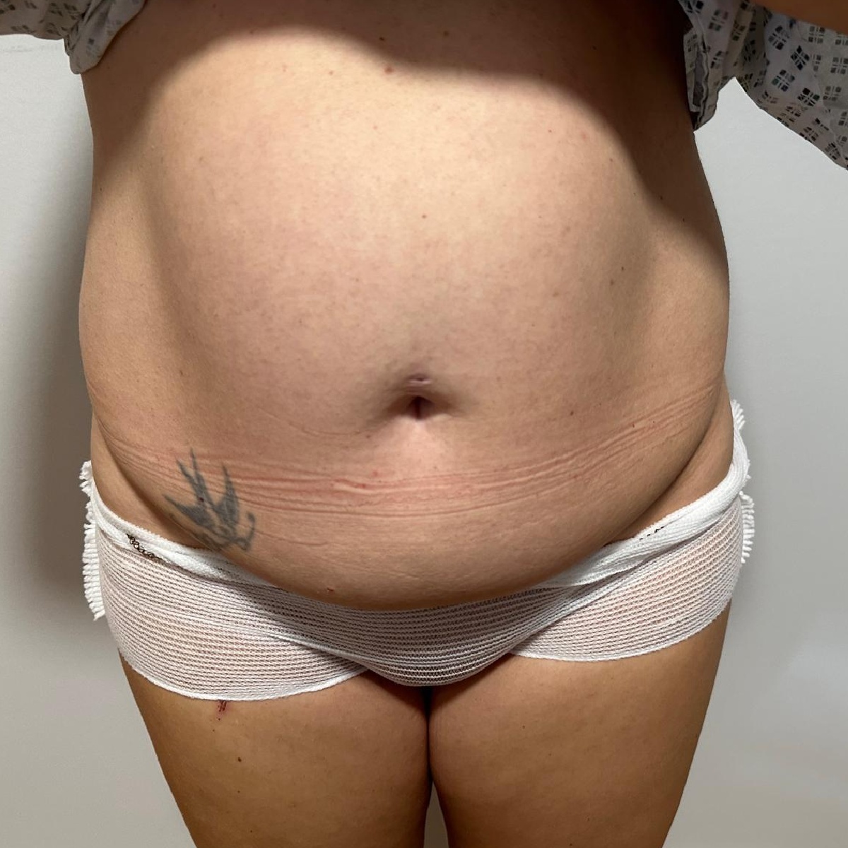 Abdominoplasty Before Front Angle with Dr. Sof