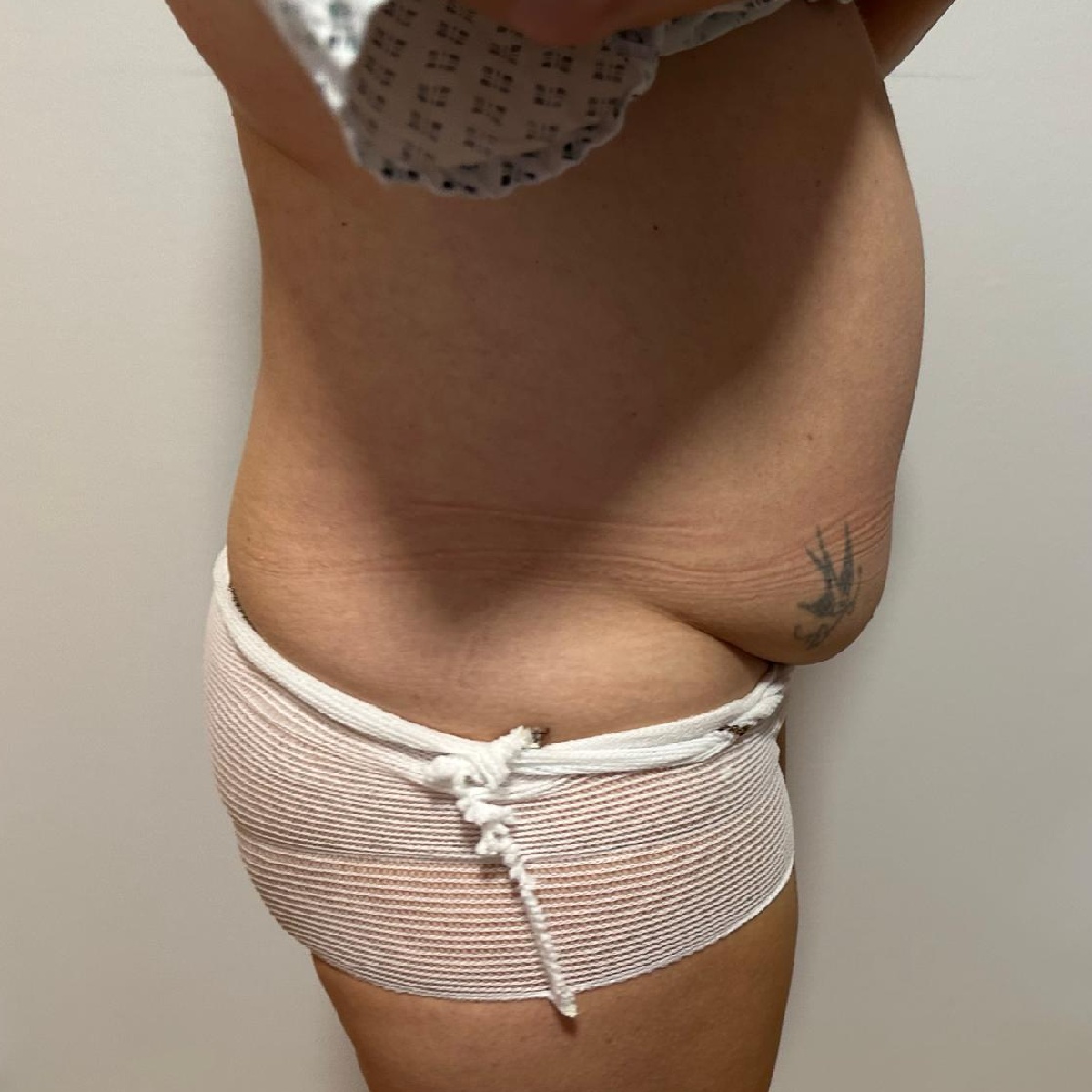 Abdominoplasty Before Side Angle 2 with Dr. Sof