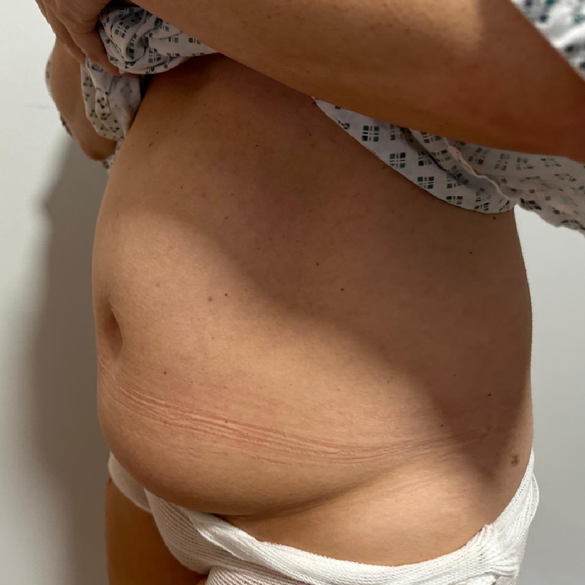 Abdominoplasty Before Side Angle with Dr. Sof