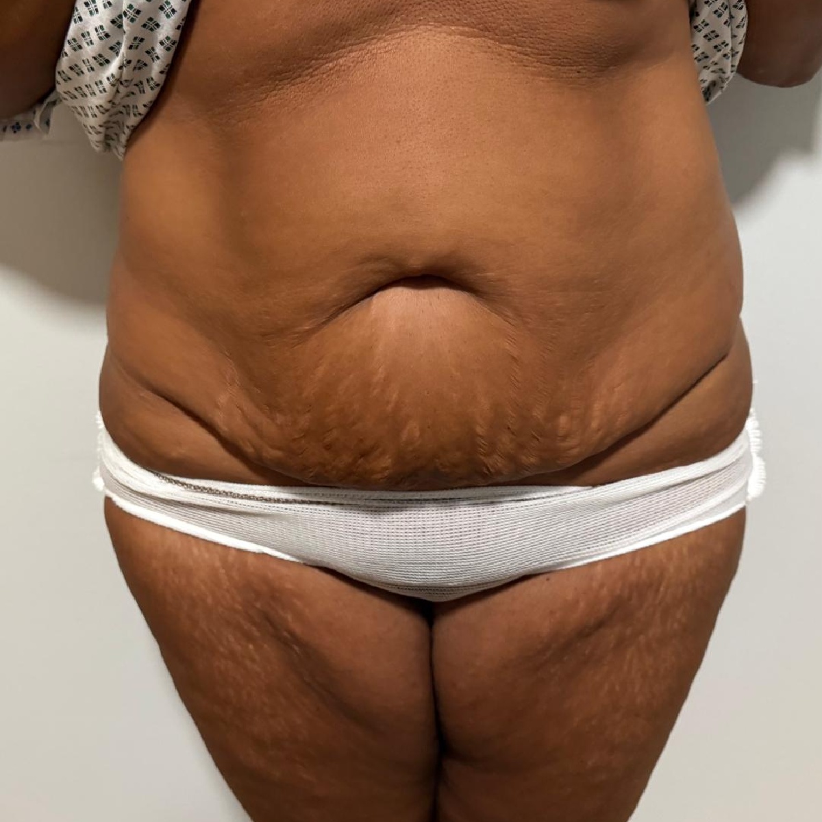 Abdominoplasty Before with Dr. Sof