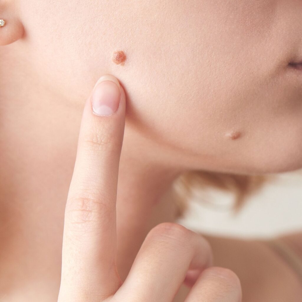 Mole Removal with Dr. Sof
