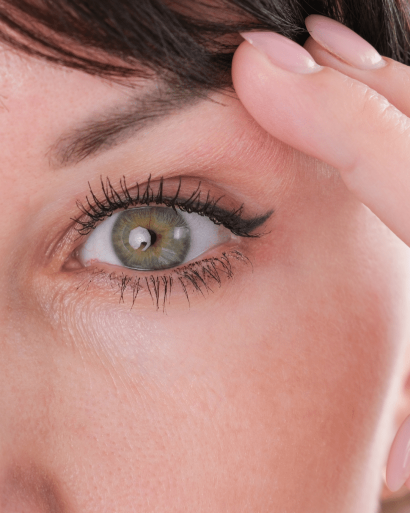 Upper Eyelid Surgery Dr. Sof UK